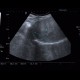 Focal nodular hyperplasia, liver: US - Ultrasound